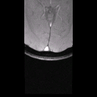 thumbs/sagittal-sinus.png