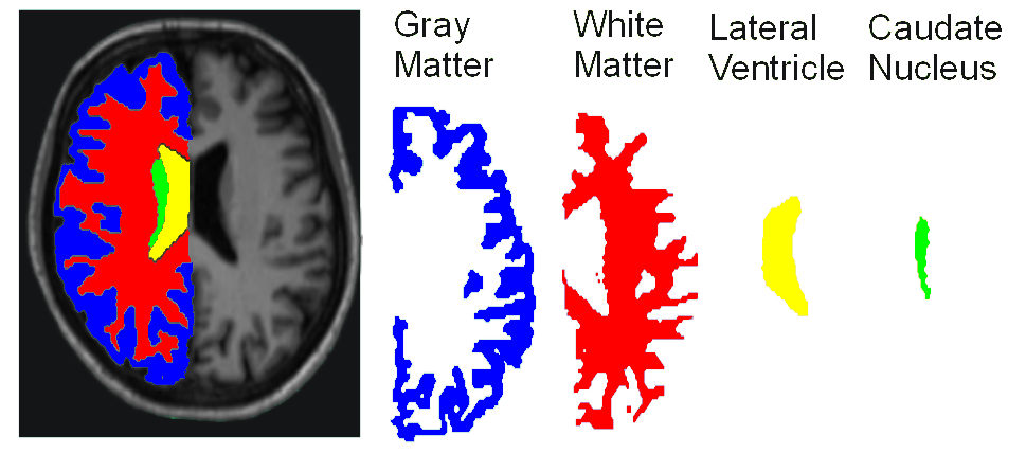 Image brain_and_labels_CAROLE